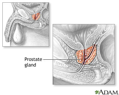 Prostate gland