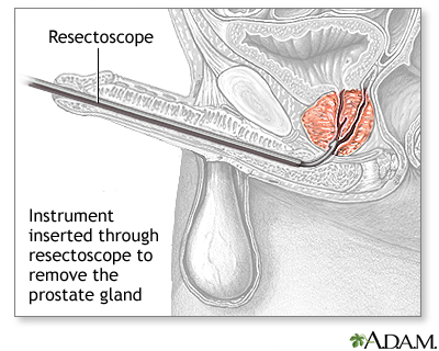 Procedure