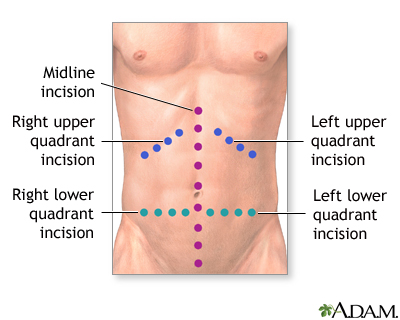 Incision