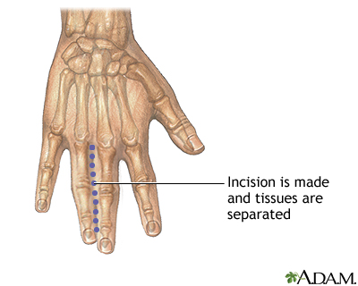 Incision