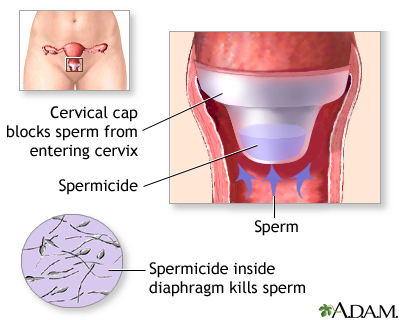 Cervical cap