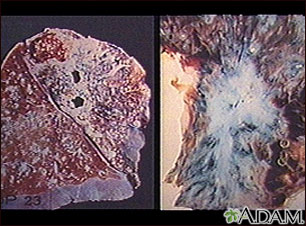 Tuberculosis in the lung