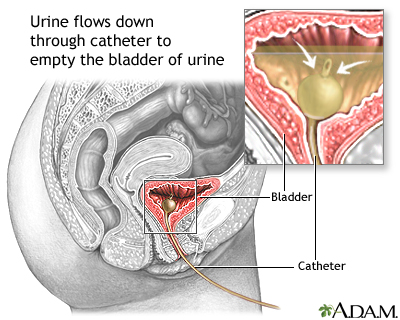 Bladder catheterization, female