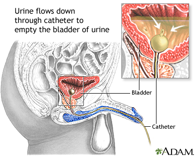 Bladder catheterization, male