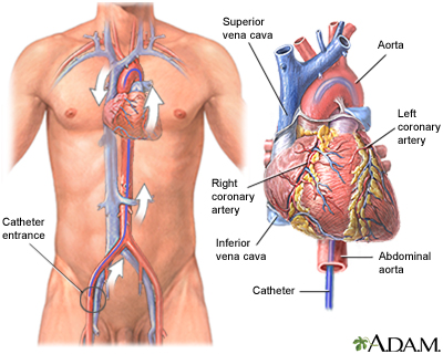 Cardiac catheterization