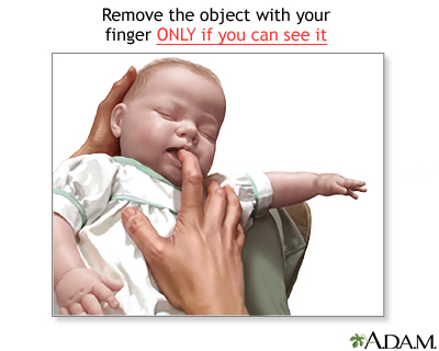 Heimlich maneuver on infant