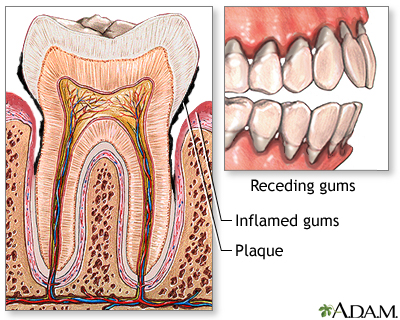 Gingivitis