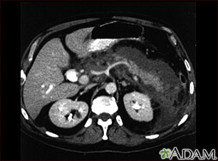 Pancreatitis, acute - CT scan