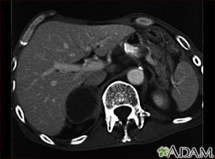 Adrenal metastases, CT scan