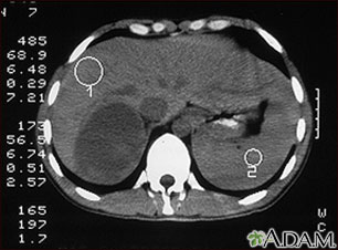 Adrenal Tumor - CT