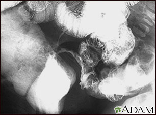 Crohn's disease, X-ray