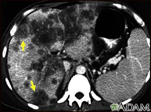 Hepatocellular cancer, CT scan