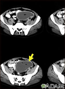 Intra-abdominal abscess, CT scan