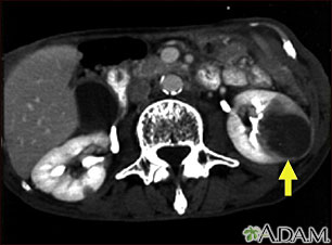 Kidney metastases, CT scan