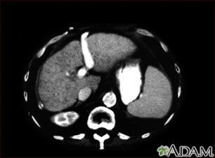 Liver cirrhosis, CT scan