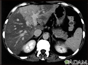 Liver with disproportional fattening, CT scan