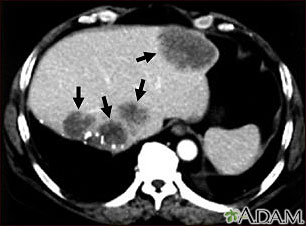 Liver metastases, CT scan