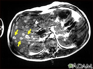 Melanoma of the liver -&#160;MRI scan