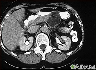 Pancreatic, cystic adenoma - CT scan