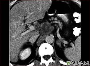 Pancreatic cancer, CT scan