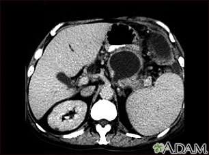 Pancreatic pseudocyst, CT scan