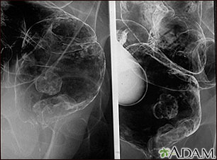 Rectal cancer, X-ray