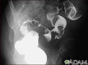 Sigmoid colon cancer, X-ray