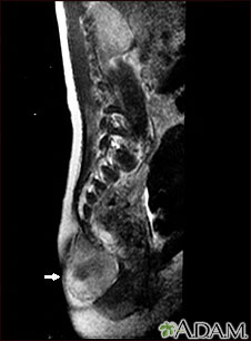 Teratoma - MRI scan