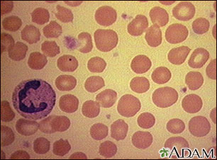 Red blood cells, spherocytosis