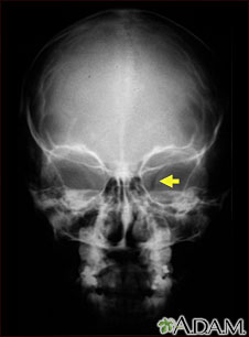 Neurofibromatosis I, enlarged optic foramen