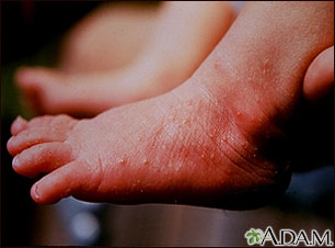 Erythema toxicum on the foot