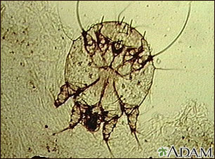 Scabies mite, photomicrograph