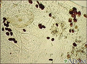 Scabies mite, photomicrograph of the stool