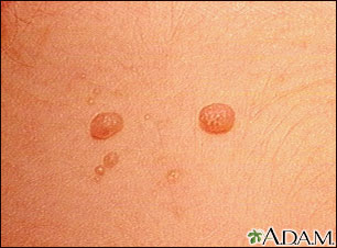 Molluscum contagiosum - close-up