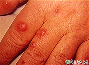 Cryptococcus, cutaneous on the hand