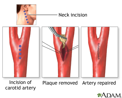 Procedure