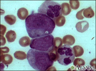 Chronic myelocytic leukemia