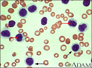 Hairy cell leukemia - microscopic view