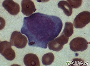 Mononucleosis, photomicrograph of cells