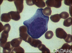 Mononucleosis, photomicrograph of cells