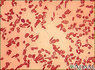 Red blood cells, sickle cells