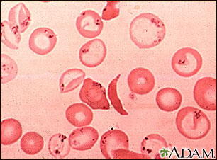 Red blood cells, sickle and pappenheimer