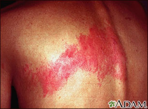 Herpes zoster (shingles) on the back