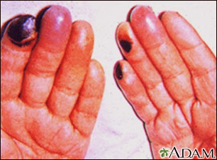 Cryoglobulinemia - of the fingers