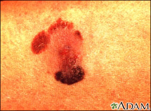 Skin cancer, malignant melanoma