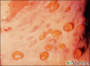 Bullous pemphigoid, close-up of tense blisters