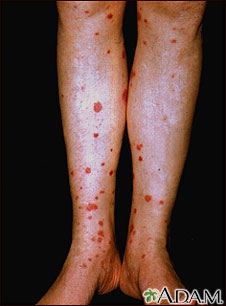 Henoch-Schonlein purpura on the lower legs