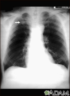 Pulmonary nodule - front view chest X-ray