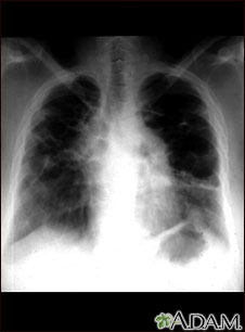 Sarcoid, stage IV - chest X-ray