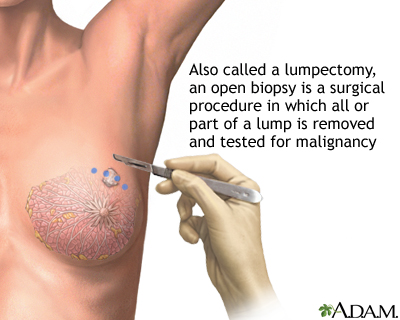 Open biopsy of the breast